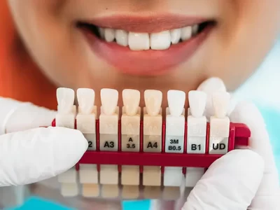Veneers Vs. Lumineers: Lifespan, Benefits, and Drawbacks