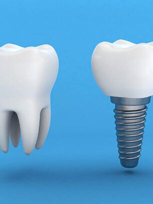 When Do Bone Grafts Become Necessary for Dental Implants?