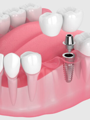 How Long Does One Have to Wait Between Implant and Crown Placement?