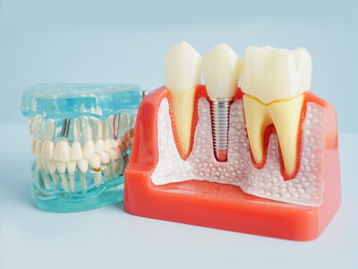 Dental Implants Can Restore Your Smile and Confidence