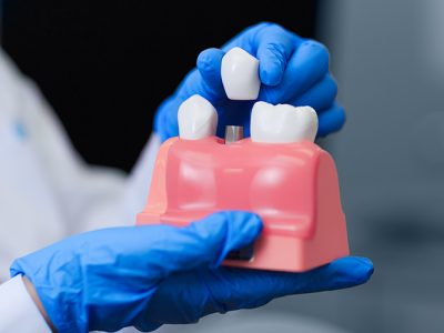 How Dental Implants Can Reinstate Your Smile and Confidence