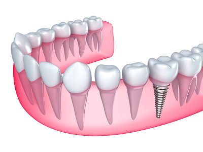 The Best Age for Getting Dental Implants in Oak Lawn, IL