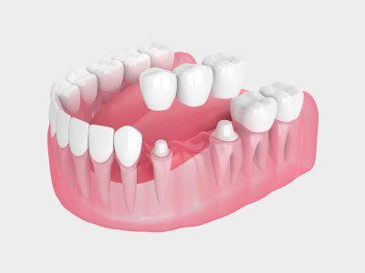 Emergency Issues With a Dental Bridge — What Oak Lawn Patients Should Do