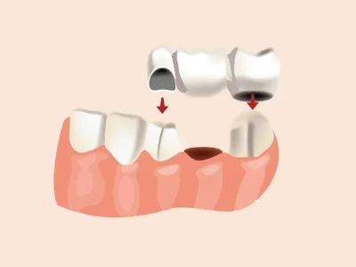Why-Many-Patients-Choose-Dental-Bridges-to-Replace-Missing-Teeth