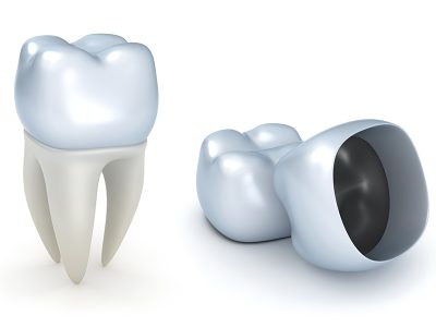 Can a Dental Crown Save My Broken Tooth?